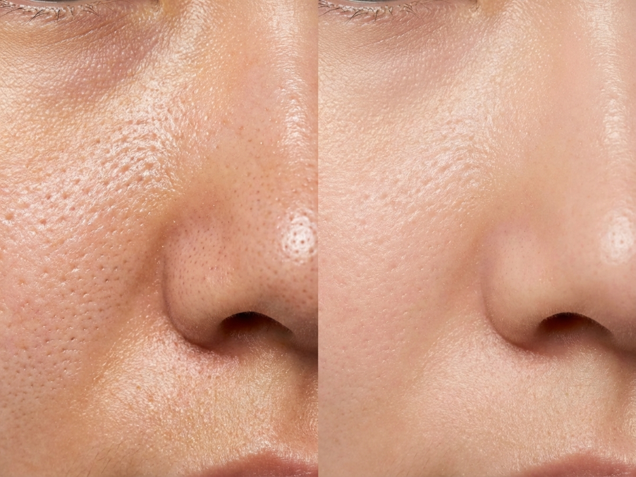 모공 축소 시술